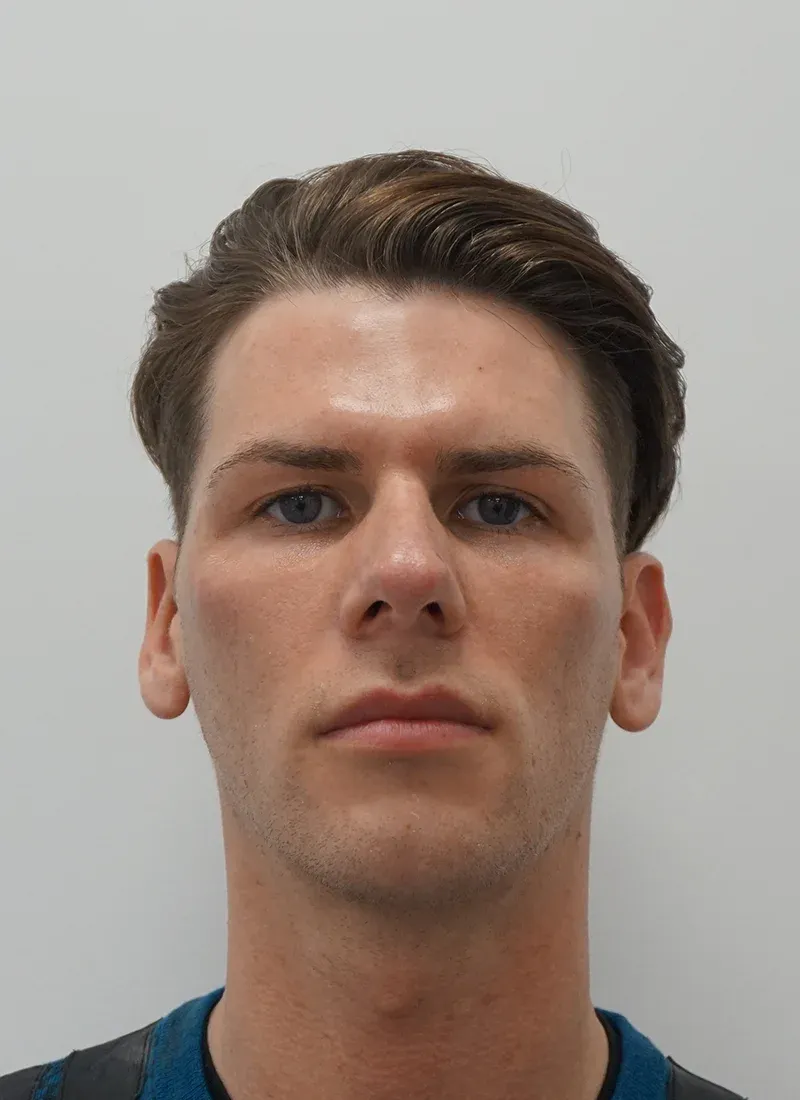 After Botox for Men at Luxe Skin Glasgow by Dr Q