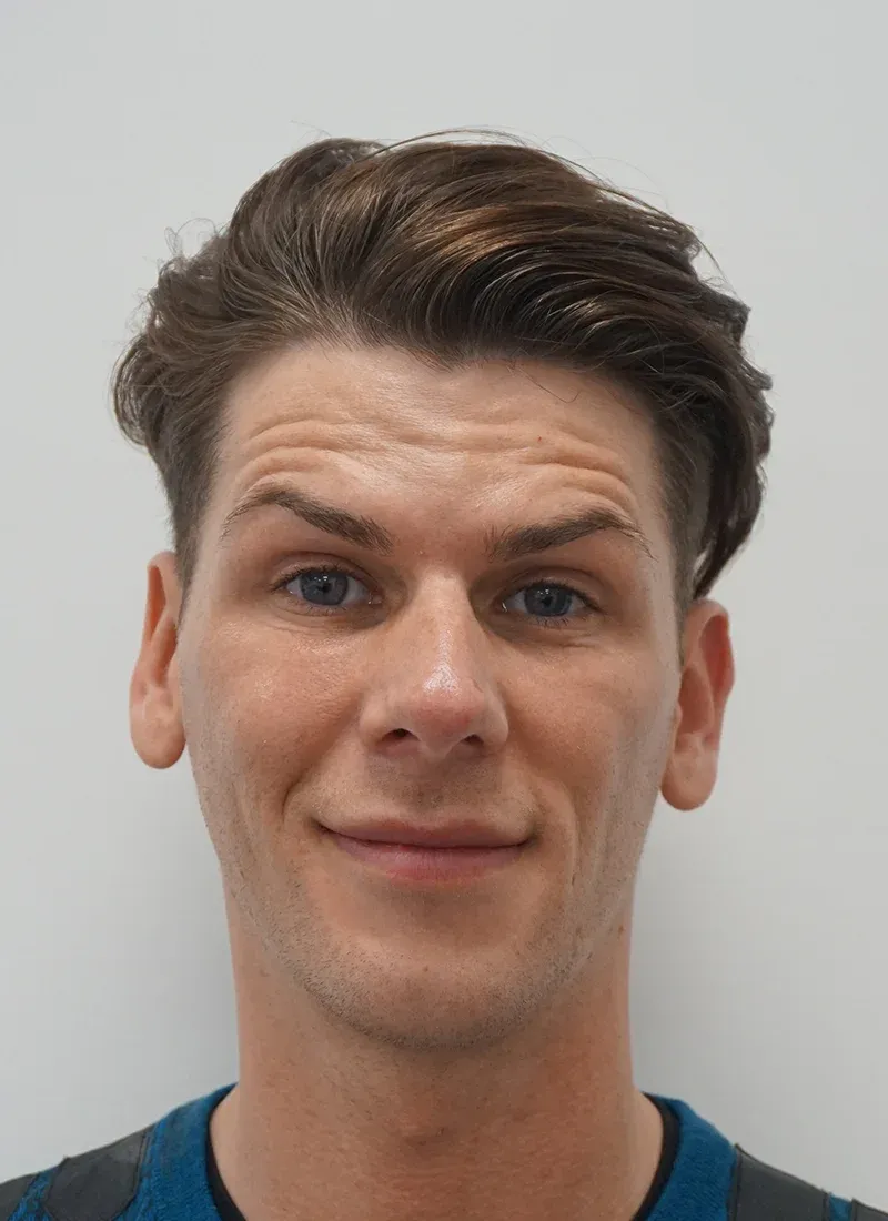 Botox for Men Before at Luxe Skin Glasgow