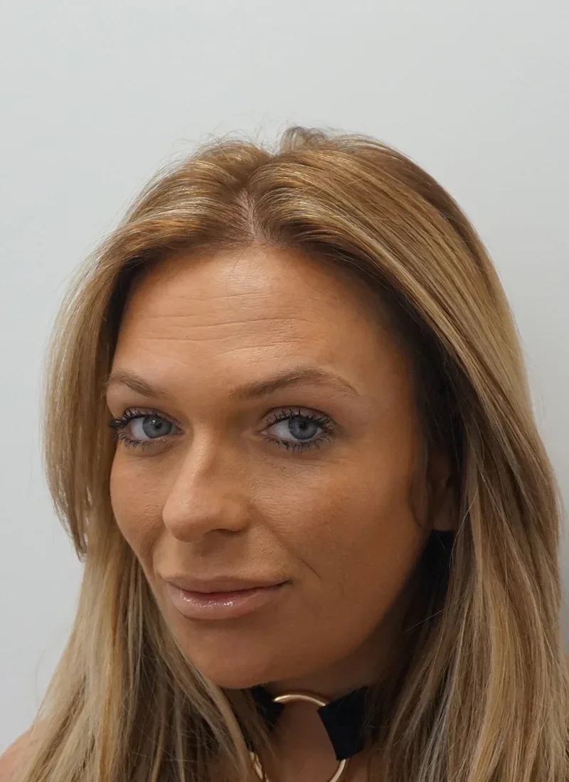 Botox, real patient of Dr Q, after