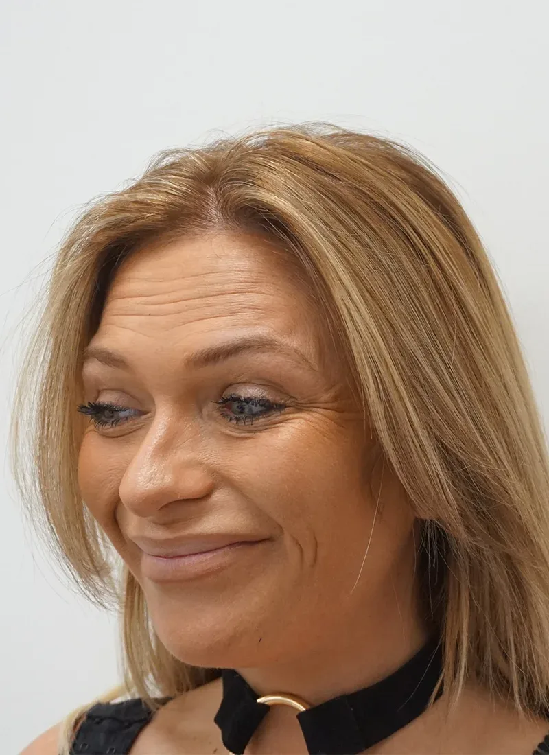 Botox, real patient of Dr Q, before