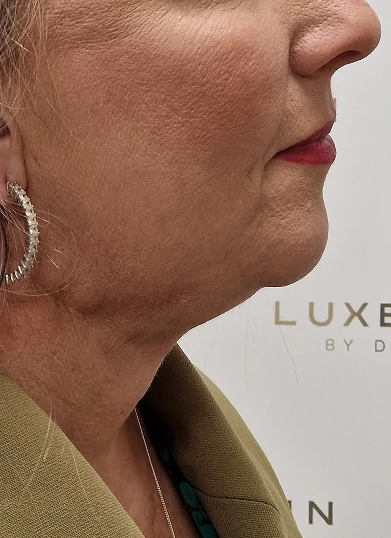 Double chin, real patient of Dr Q, after