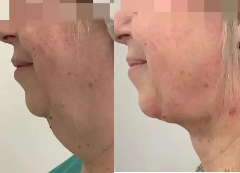 Visible improvement after advanced aesthetic treatment