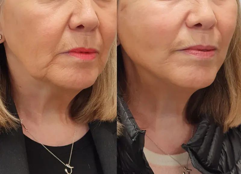 Before and after showcasing refined aesthetic results