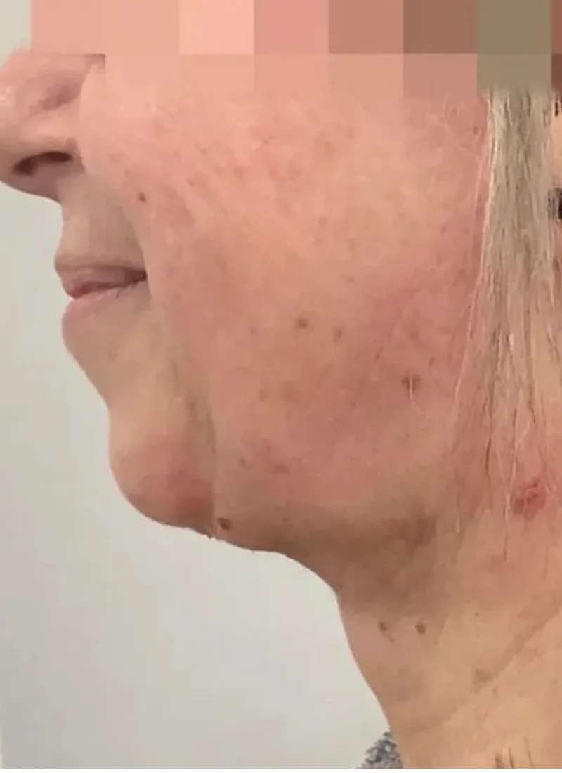 Endodefine laser facelift, real patient of Dr Q, after