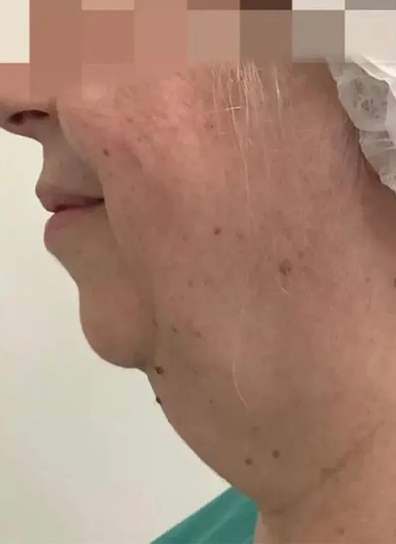 Endodefine laser facelift, real patient of Dr Q, before