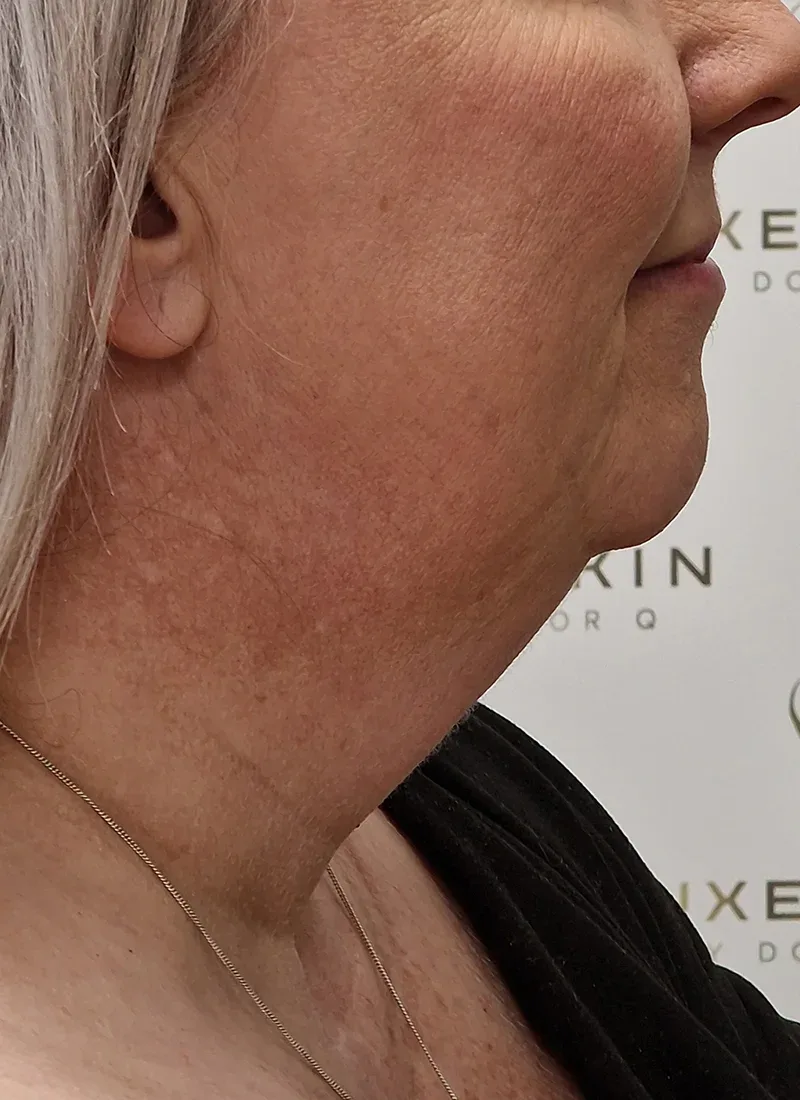 Necklift, real patient of Dr Q, before
