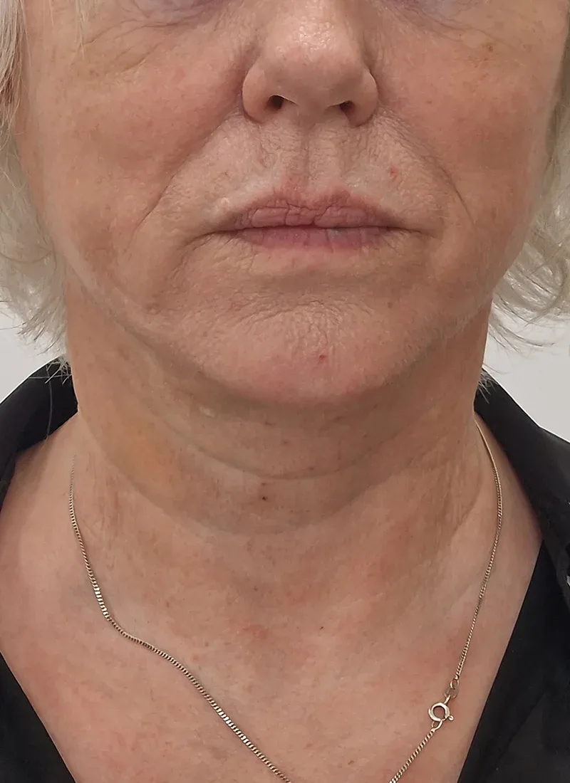Non surgical facelift, real patient of Dr Q, after