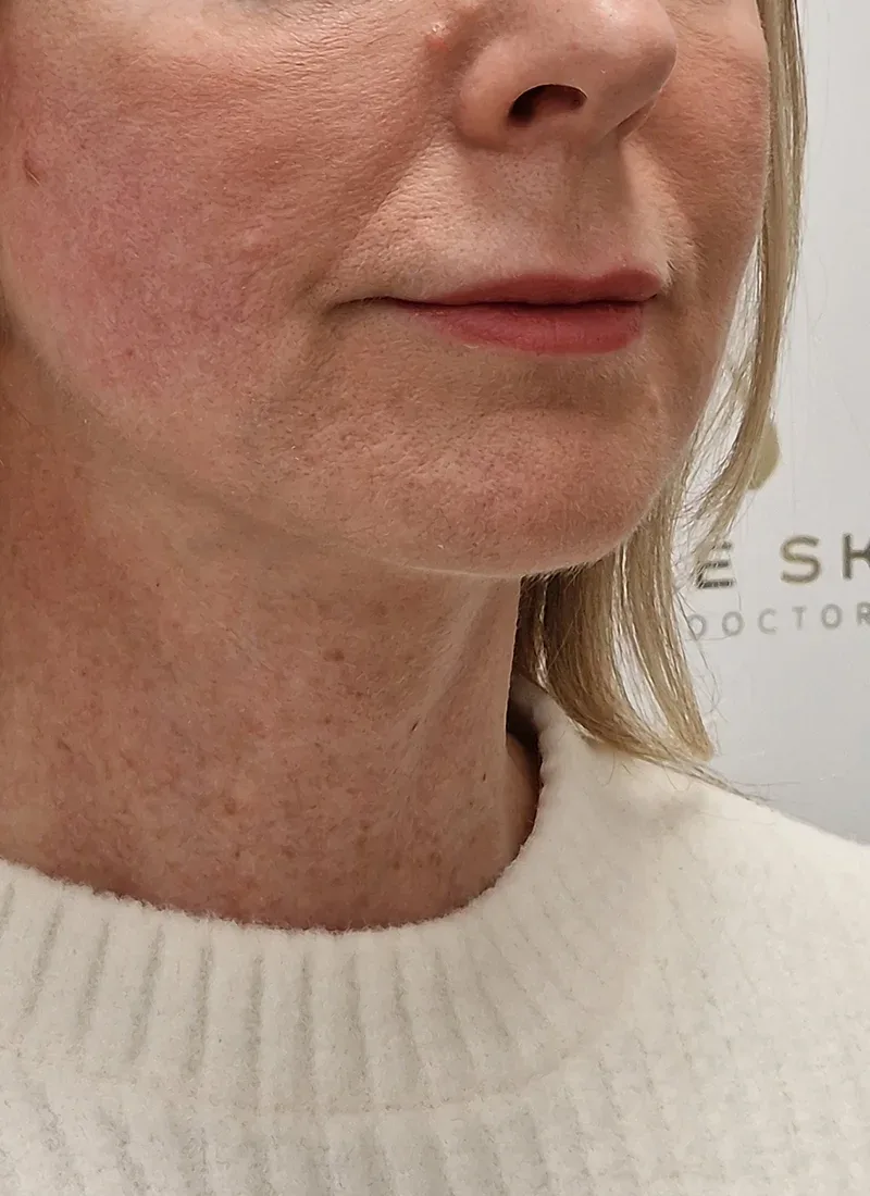 Q Lift, real patient of Dr Q, after