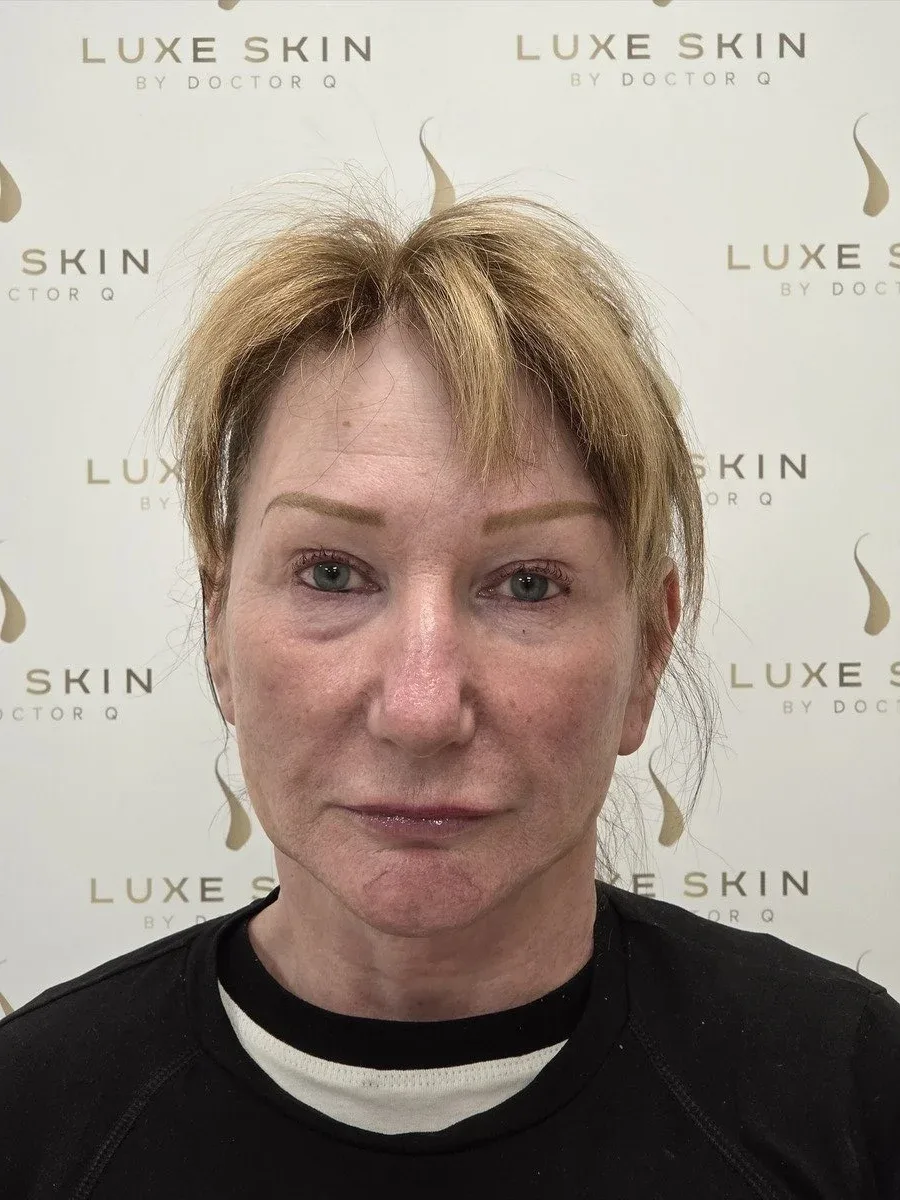 Betty, 60, Q-Lift Ultimate face, neck and brow lift, after