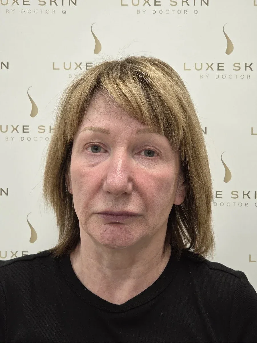 Betty, 60, Q-Lift Ultimate face, neck and brow lift, before